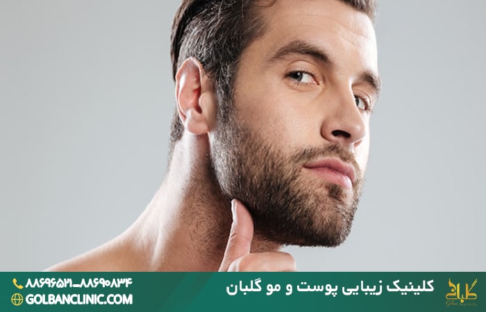 کاشت مو از ریش به سر