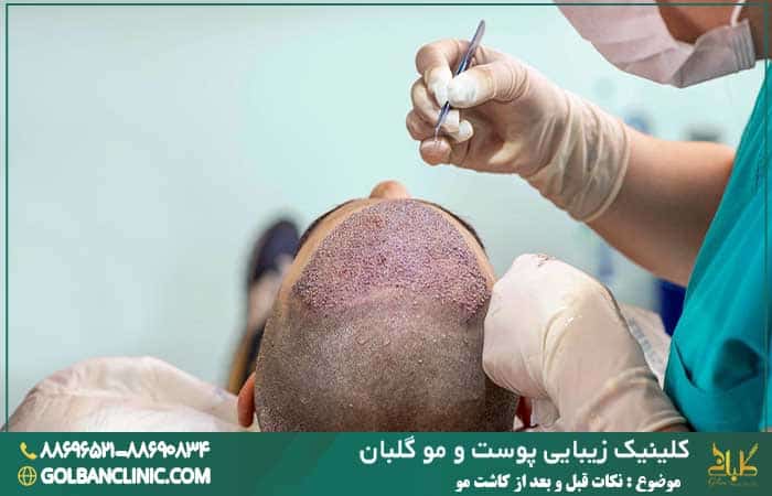 کاشت مو مستلزم رعایت نکاتی قبل و بعد از انجام آن است