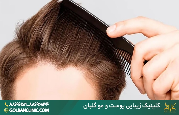 عوارض کاشت مو