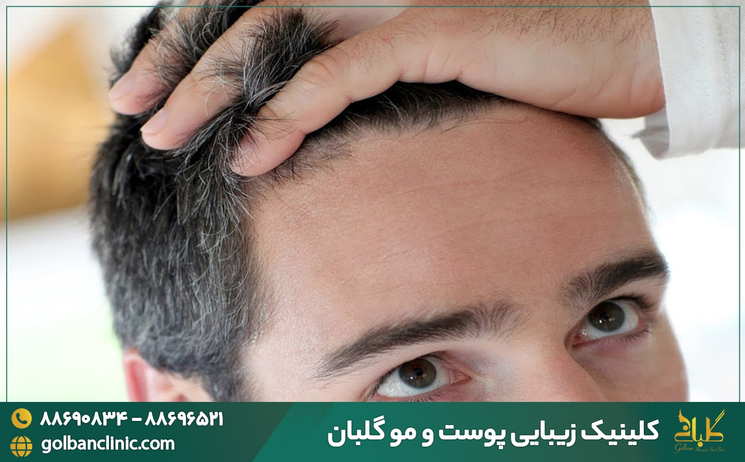 کاشت مو به روش FUT