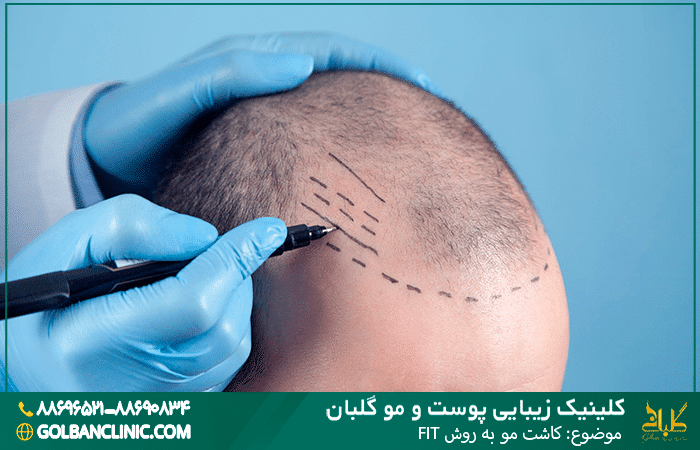 کاشت مو به روش FIT