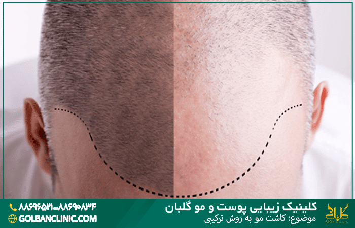 کاشت مو به روش ترکیبی
