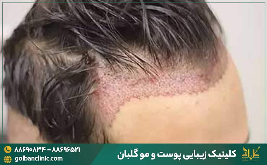  عوارض کاشت مو چیست؟