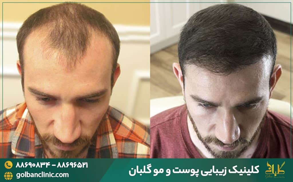 مراحل کشات مو