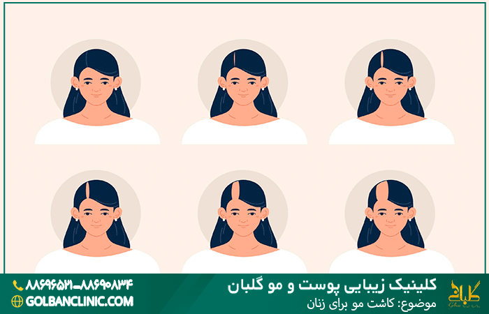 کاشت مو برای زنان