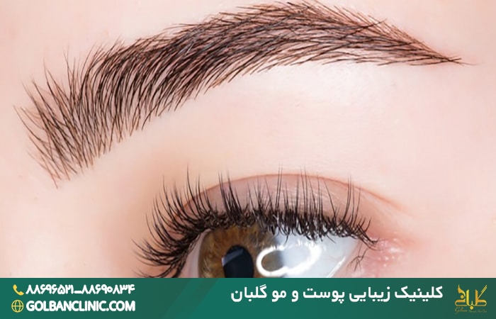 مراقبت های بعد از کاشت ابرو