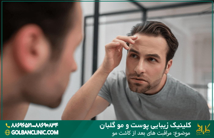 مراقبت های بعد از کاشت مو