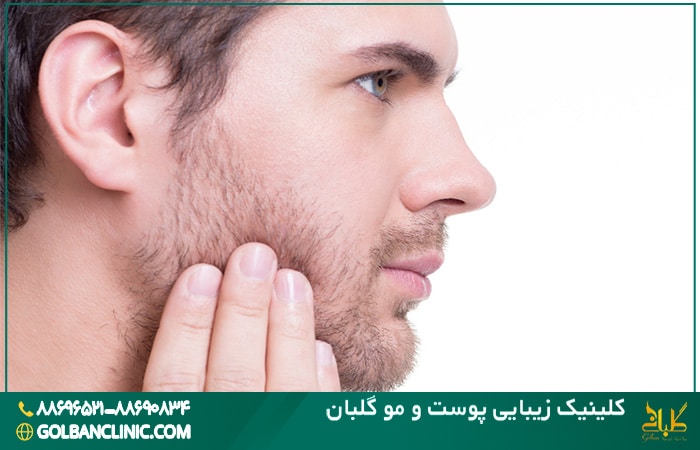 کاشت ریش و سبیل