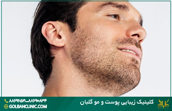 کاشت ریش و سبیل