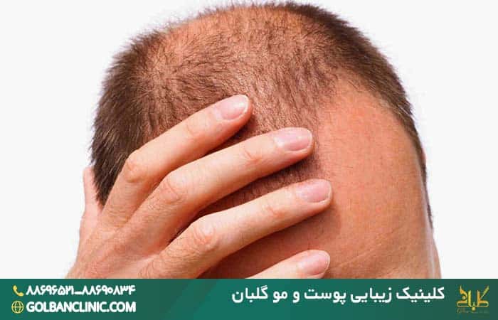 ریزش مو بعد از کاشت مو