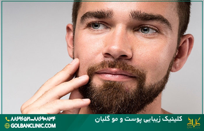 کاشت ریش و سبیل