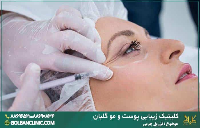 تزریق چربی در کلینیک گلبان