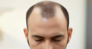 مدیتیشن بعد از کاشت مو برای آرامش و تسریع رشد مو