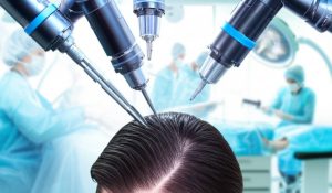 کاشت موی طبیعی با تکنولوژی پیشرفته 2025 در کلینیک گلبان